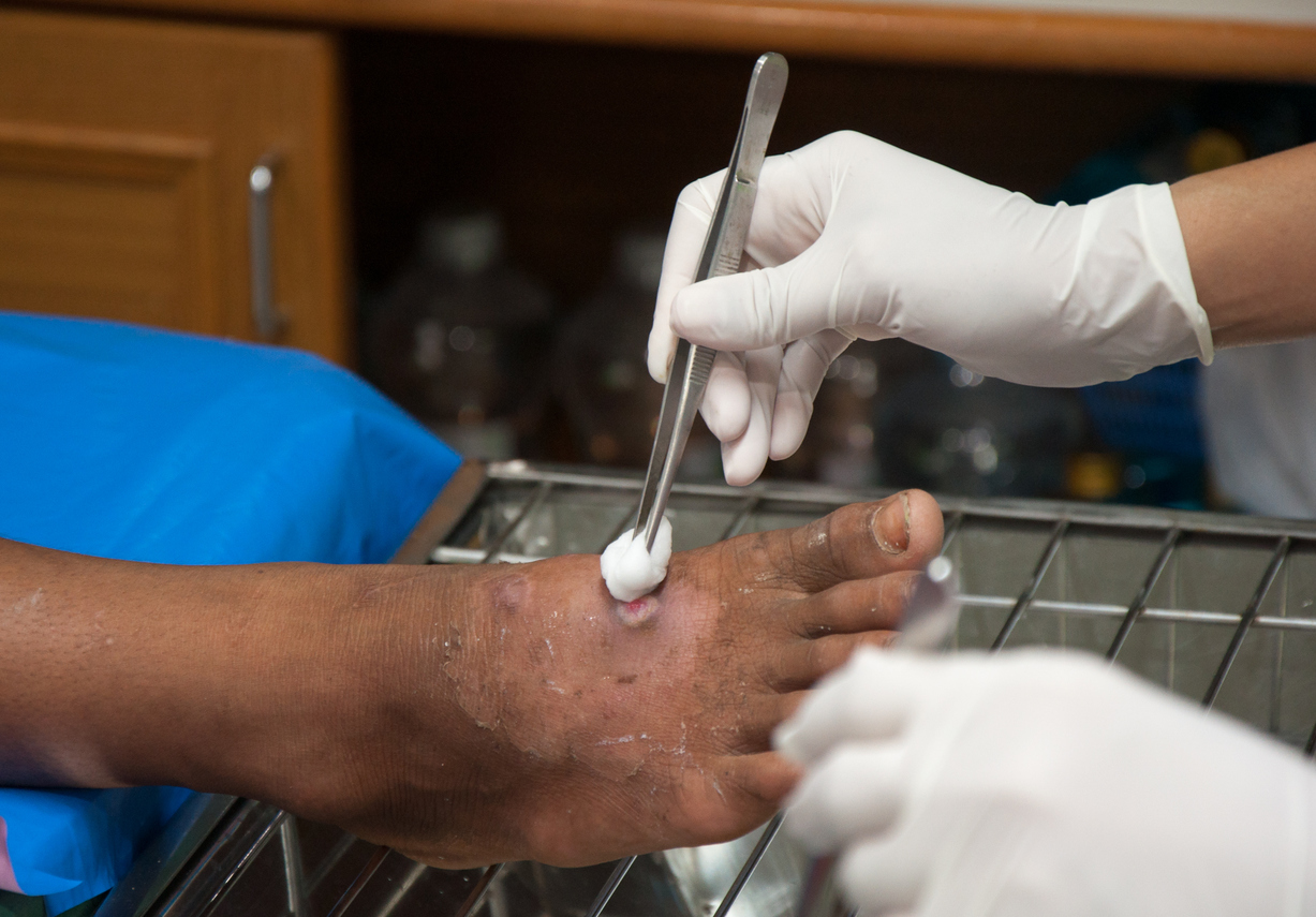 Nurses for Wound Dressing at Home In Balliwala, Dehradun