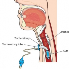 Tracheostomy Tube